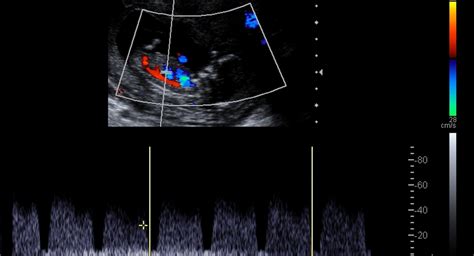 doppler maternaler gefäße|Doppler ultrasound in obstetrics